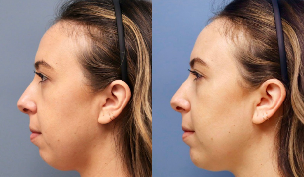 Chin Dermal Filler: What to Expect Before, During, and After Treatment