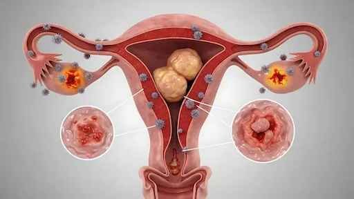 Lifestyle Changes After Uterine Cancer Treatment